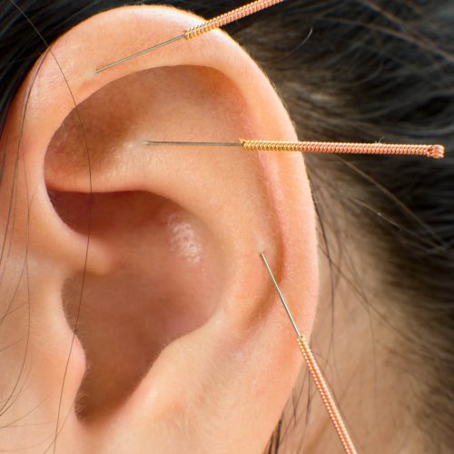 Ohrakupunktur - ein bewährtes Naturheilverfahren